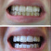 Glory Smile ™ Teeth Whitening Kit - Overrask.no