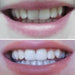 Glory Smile ™ Teeth Whitening Kit - Overrask.no