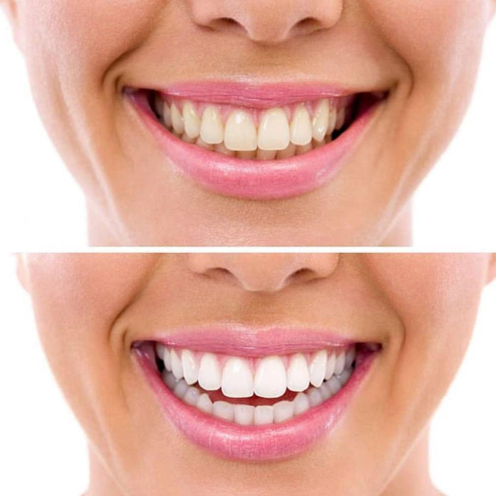 Glory Smile ™ Teeth Whitening Kit - Overrask.no