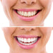 Glory Smile ™ Teeth Whitening Kit - Overrask.no