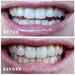 Glory Smile ™ Teeth Whitening Kit - Overrask.no